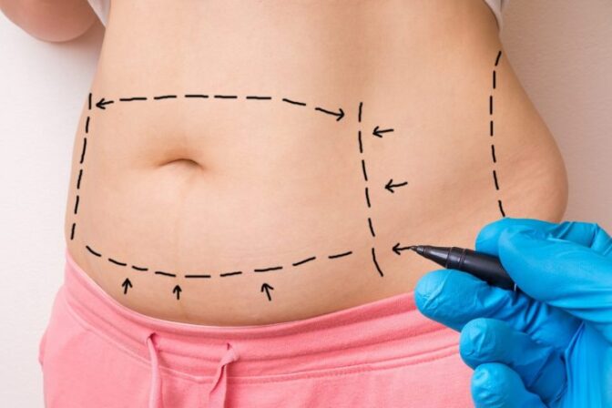 Abdominioplastia en Bogotá Dr Jorge Poveda