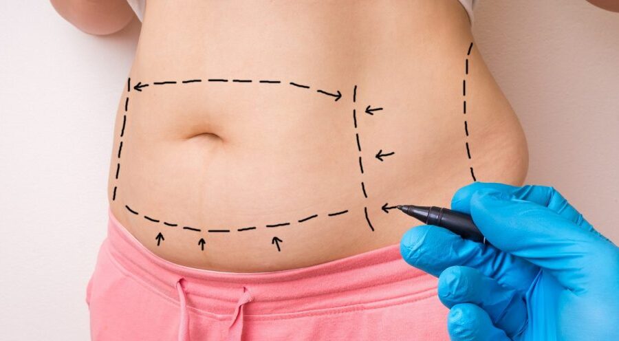 Abdominioplastia en Bogotá Dr Jorge Poveda