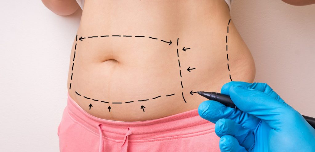 Abdominioplastia en Bogotá Dr Jorge Poveda